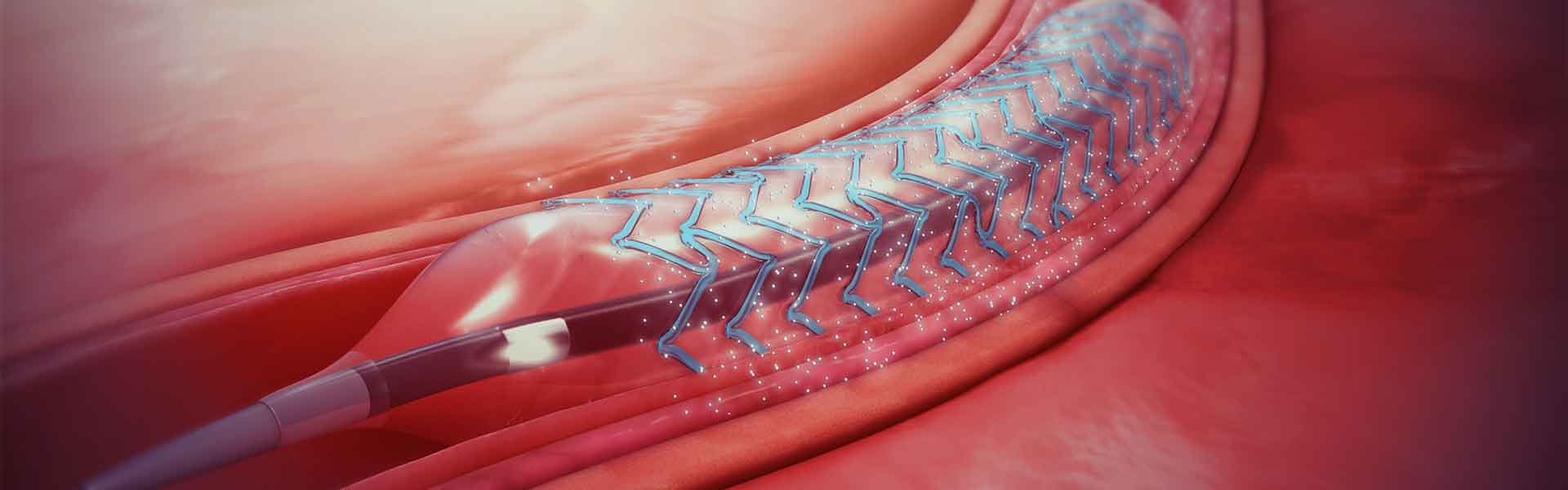 What Is A Better Option For Angioplasty A Bare Metal Stent Or A Drug
