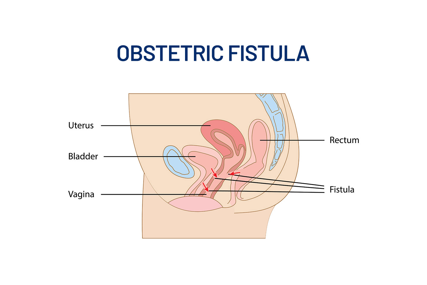 Symptoms of Obstetric Fistula and the New-Age Treatment Options Currently Available