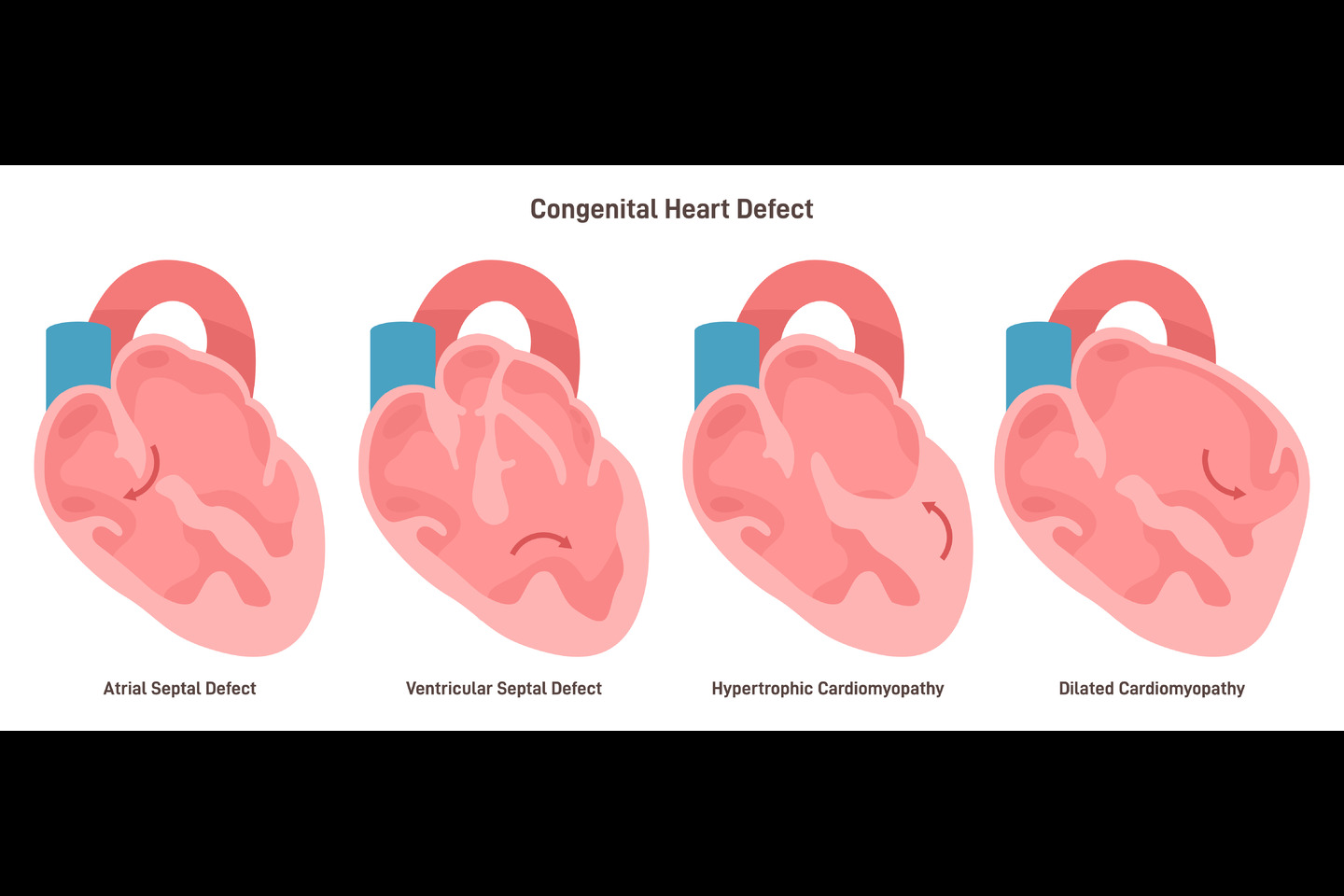 Congenital Heart Disease