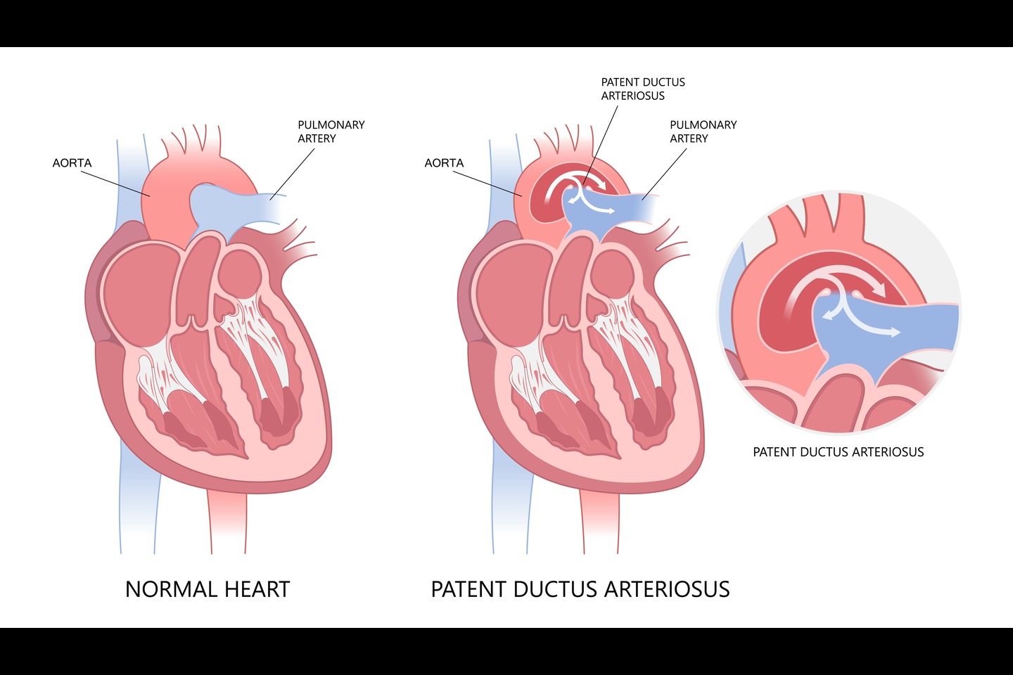 Patent Ductus Arteriosus