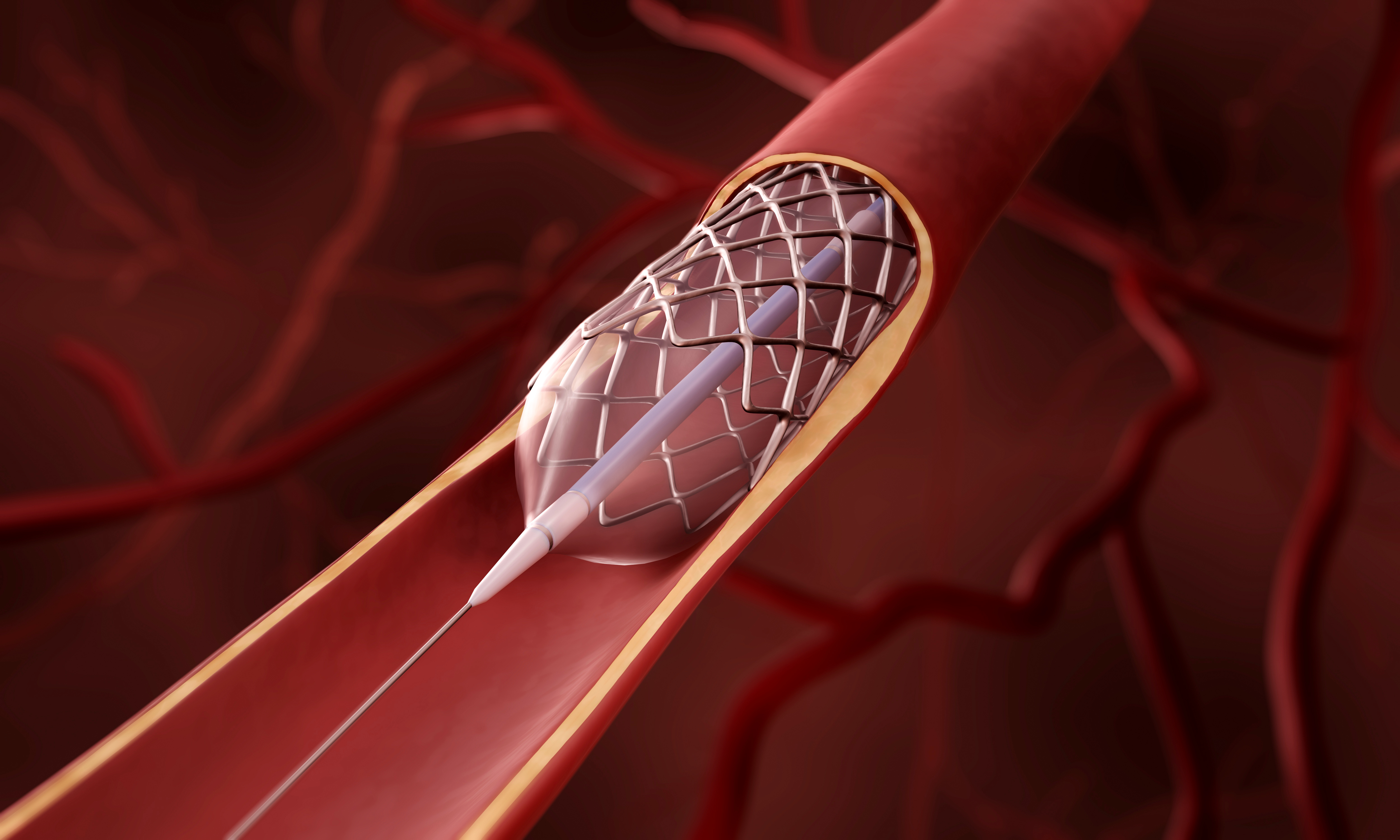 Drug-Eluting Stents