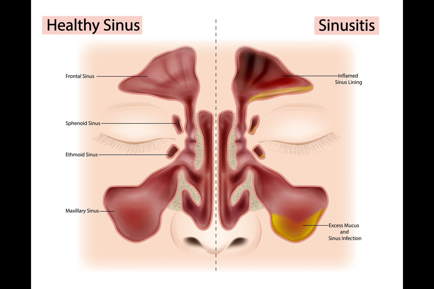 Sinusitis Worsens