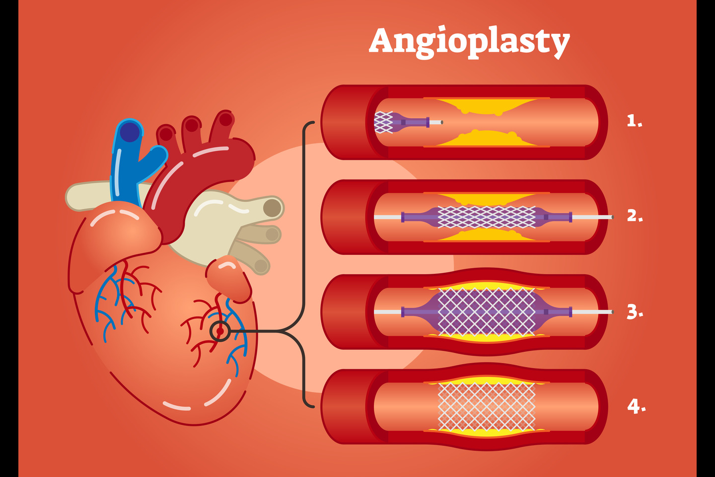 Percutaneous Coronary Intervention- Restenosis & The Role of Bare Metal Stents and Drug Eluting Stents in Preventing It.