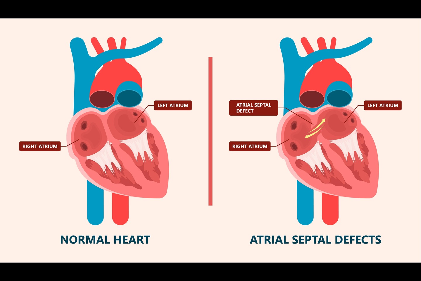 Atrial Septal Defect