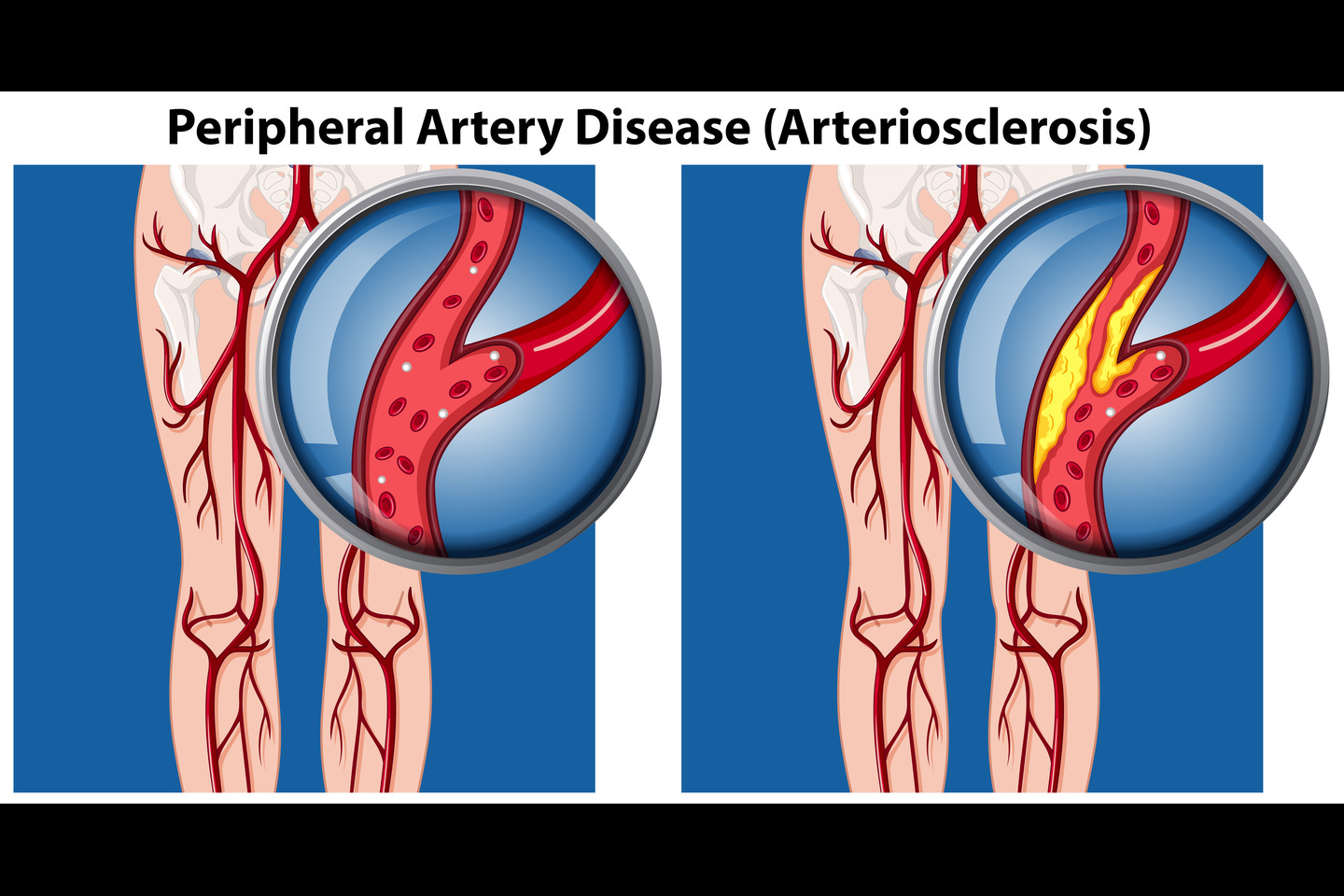 Peripheral Stents