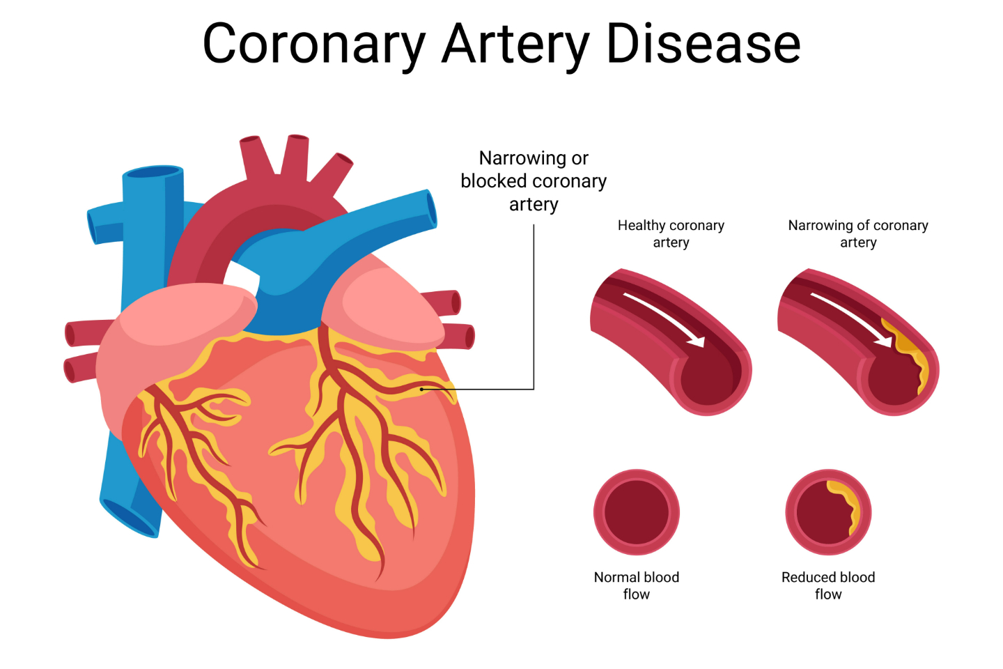 Genetics in Coronary Artery Disease