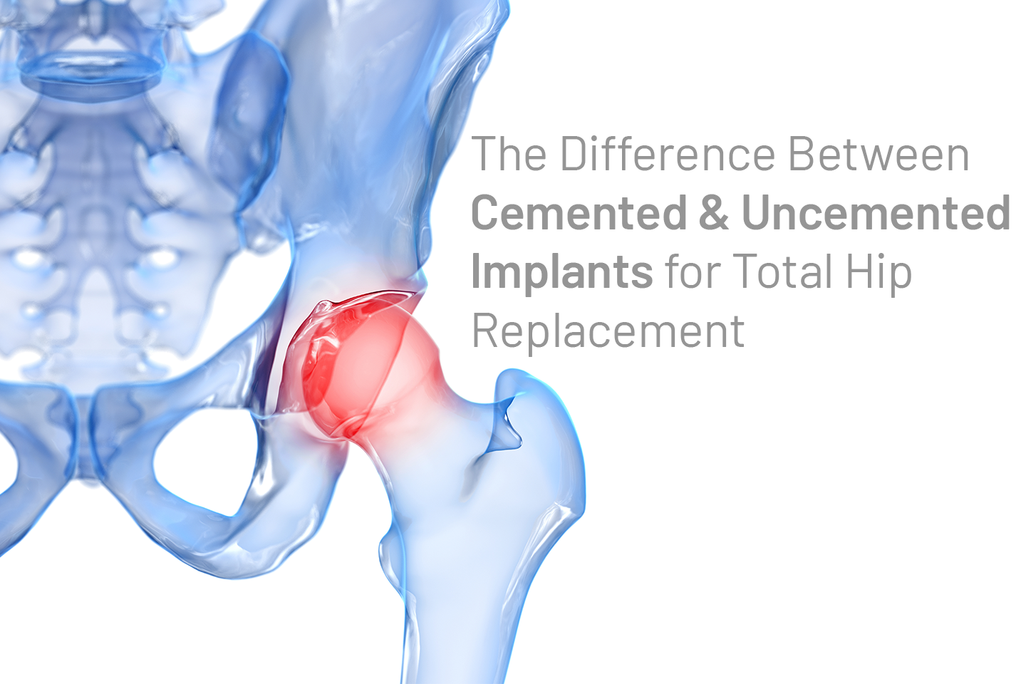 cemented and uncemented implants for total hip replaceme