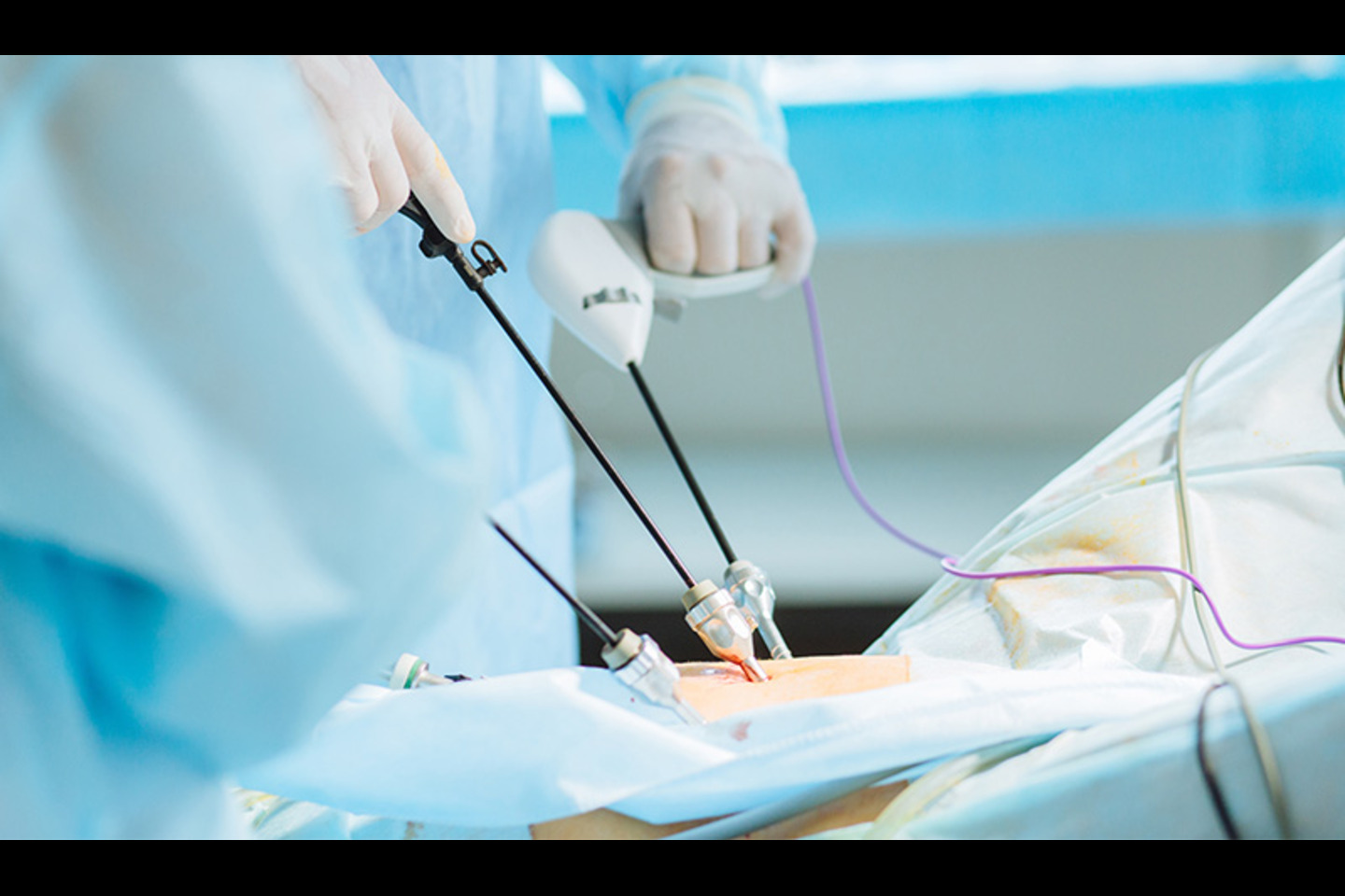 Role of Laparoscopic Surgery in Treating Hernias