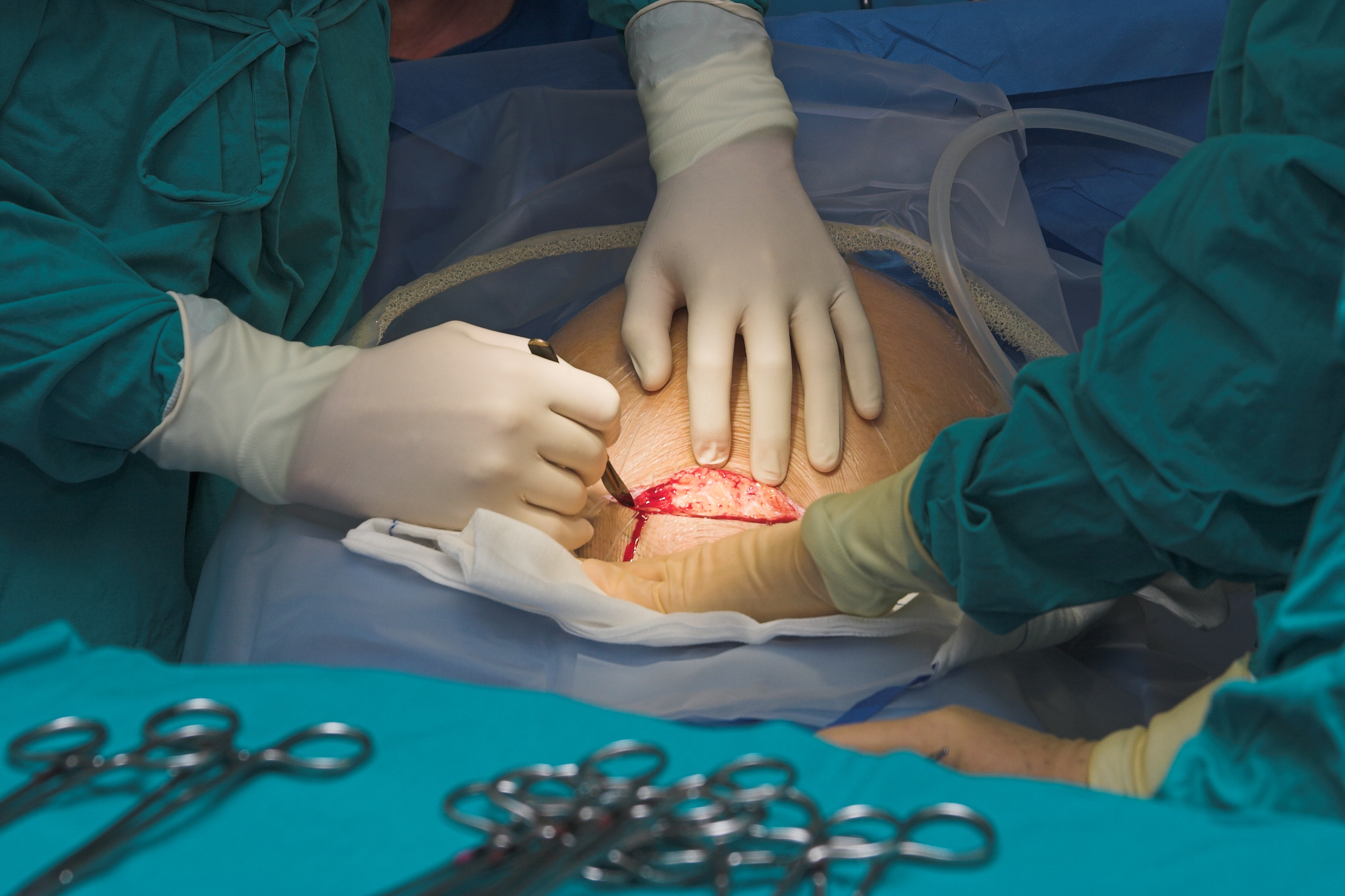 How Many Stitches Are Required for a C-Section (Cesarean Birth)?