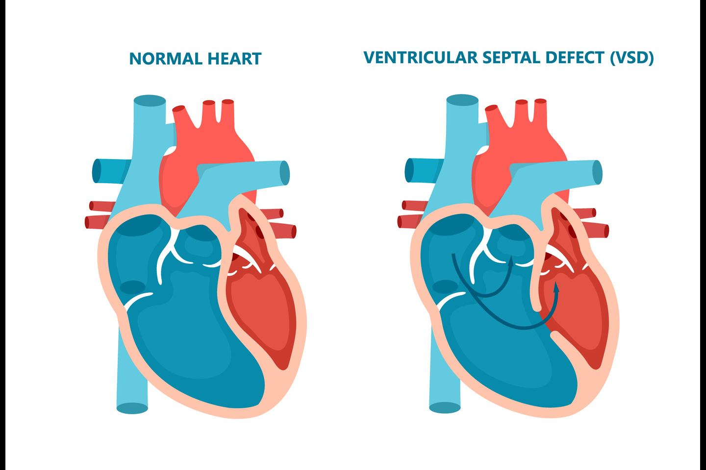 The Impact of Ventricular Septal Defect on Day-To-Day Life