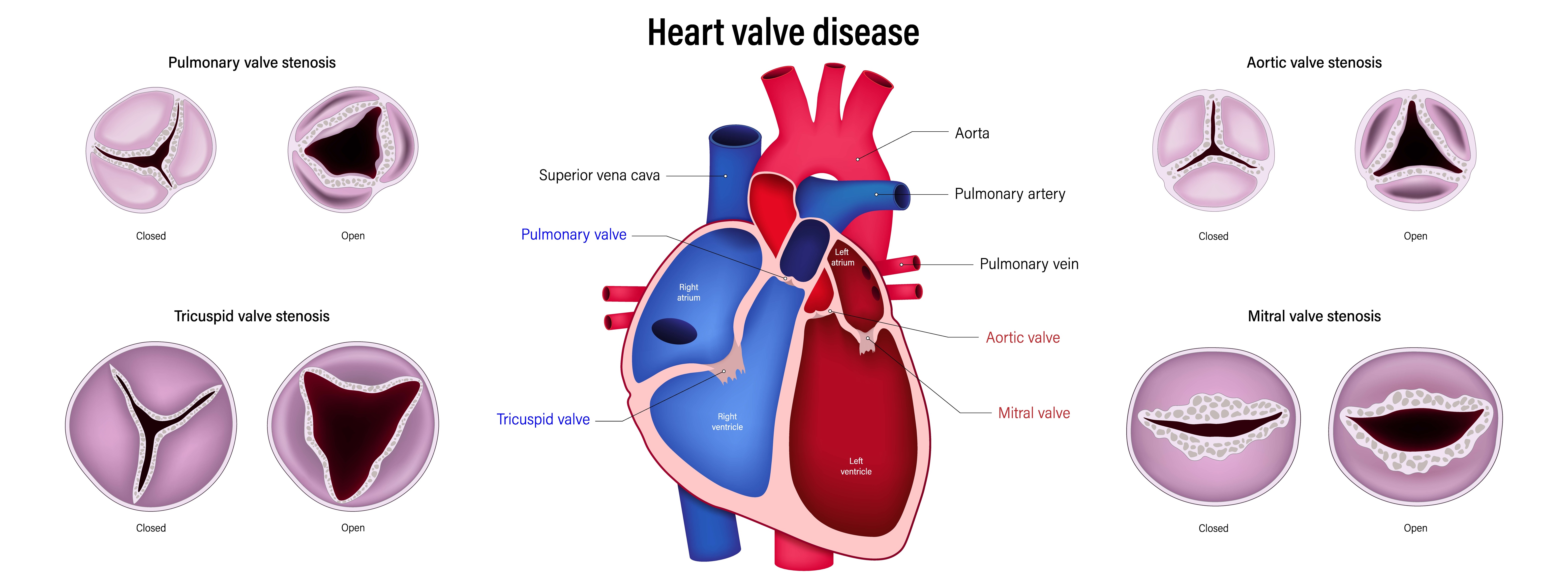Understanding heart valve diseases and treatment options