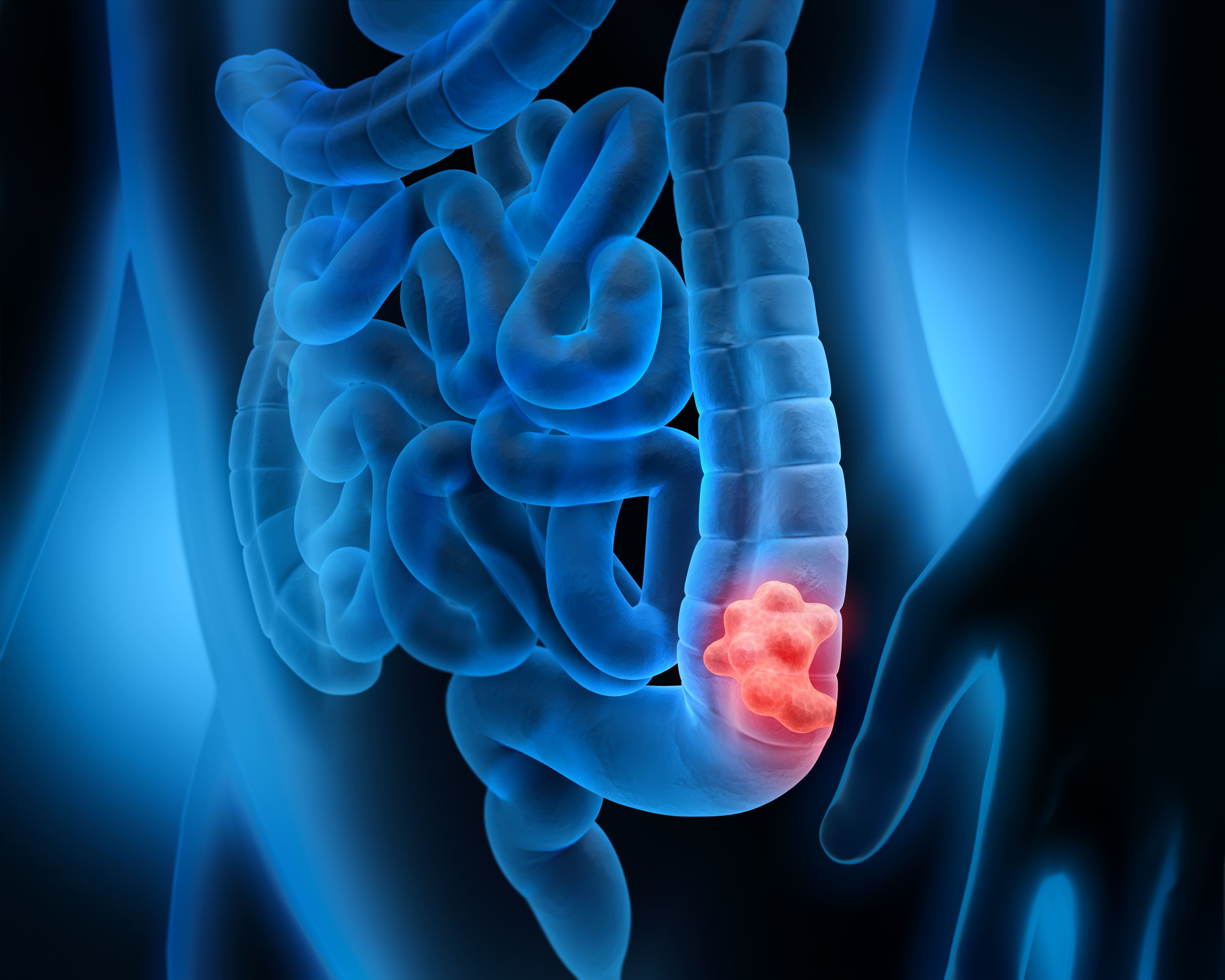 colon cancer stool pictures