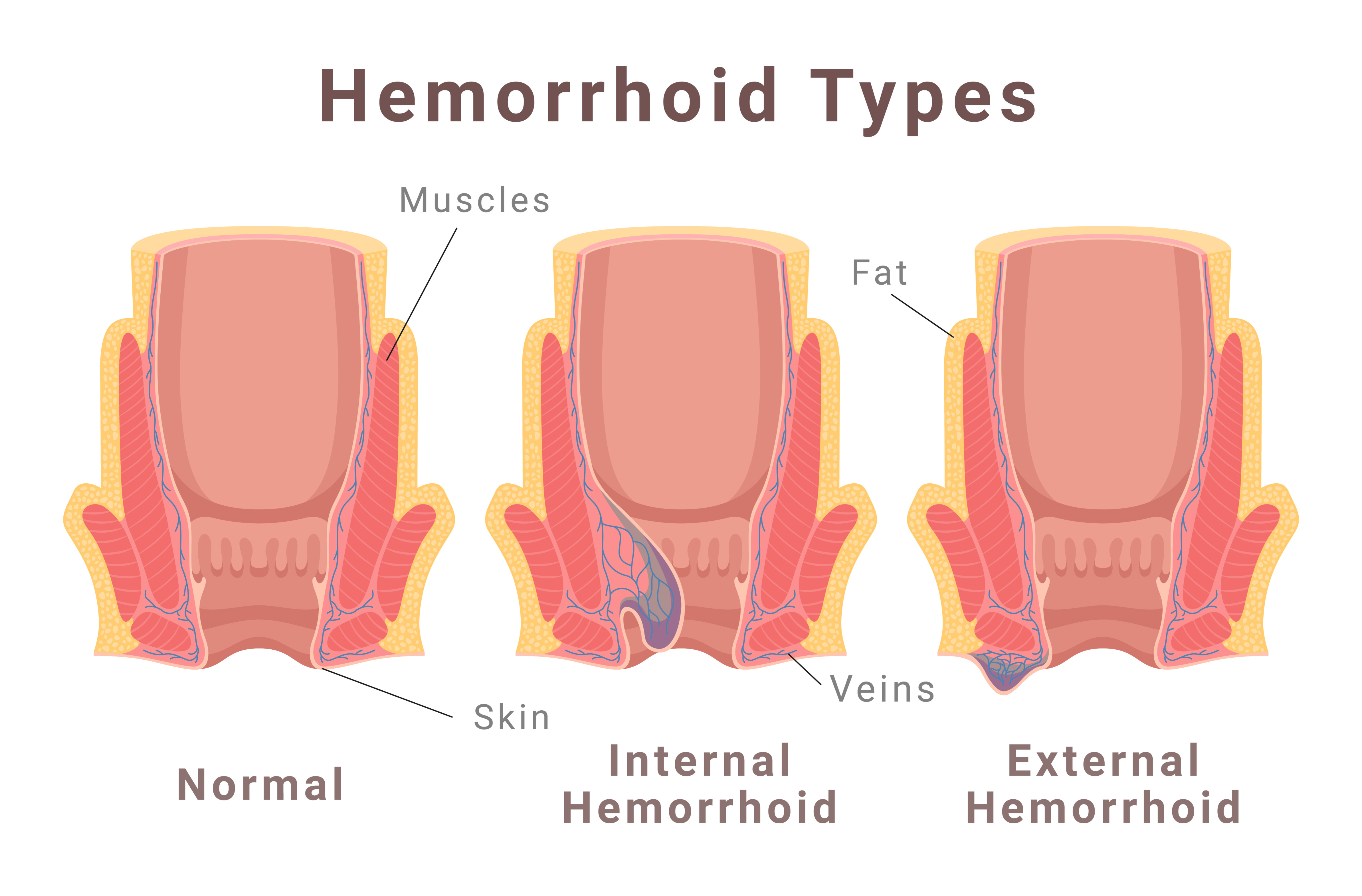 internal vs external hemorrhoids