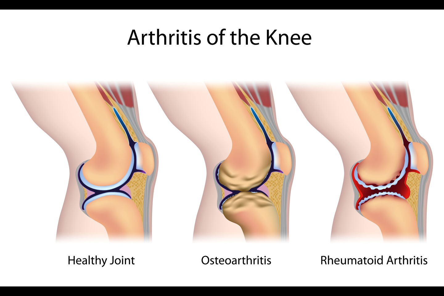 World Arthritis Day