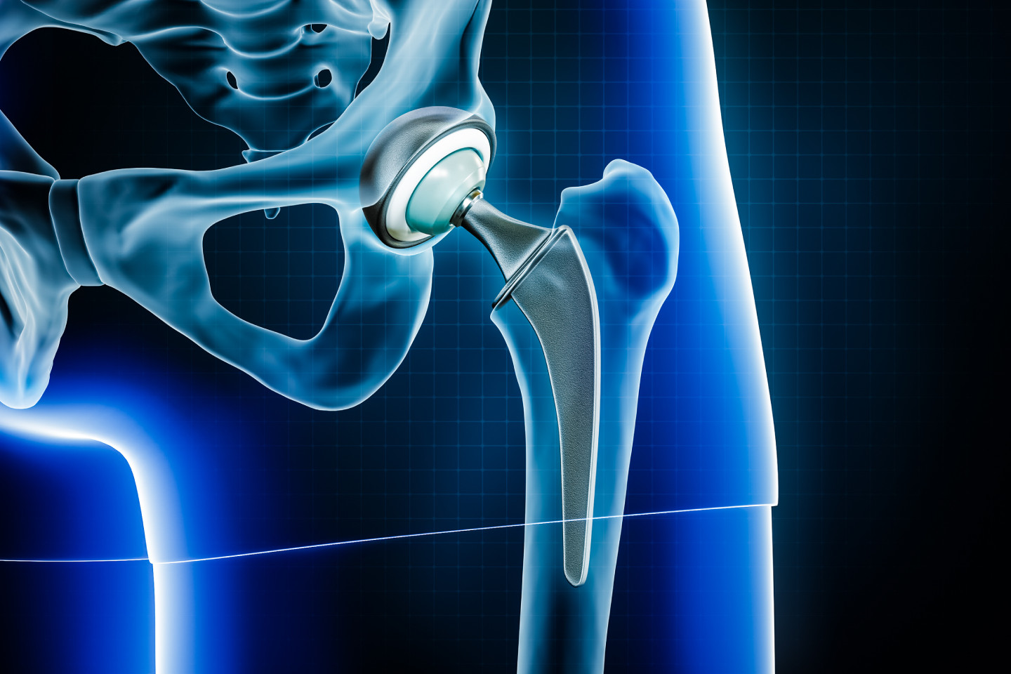 Hip Replacement Surgery and its types, Blog
