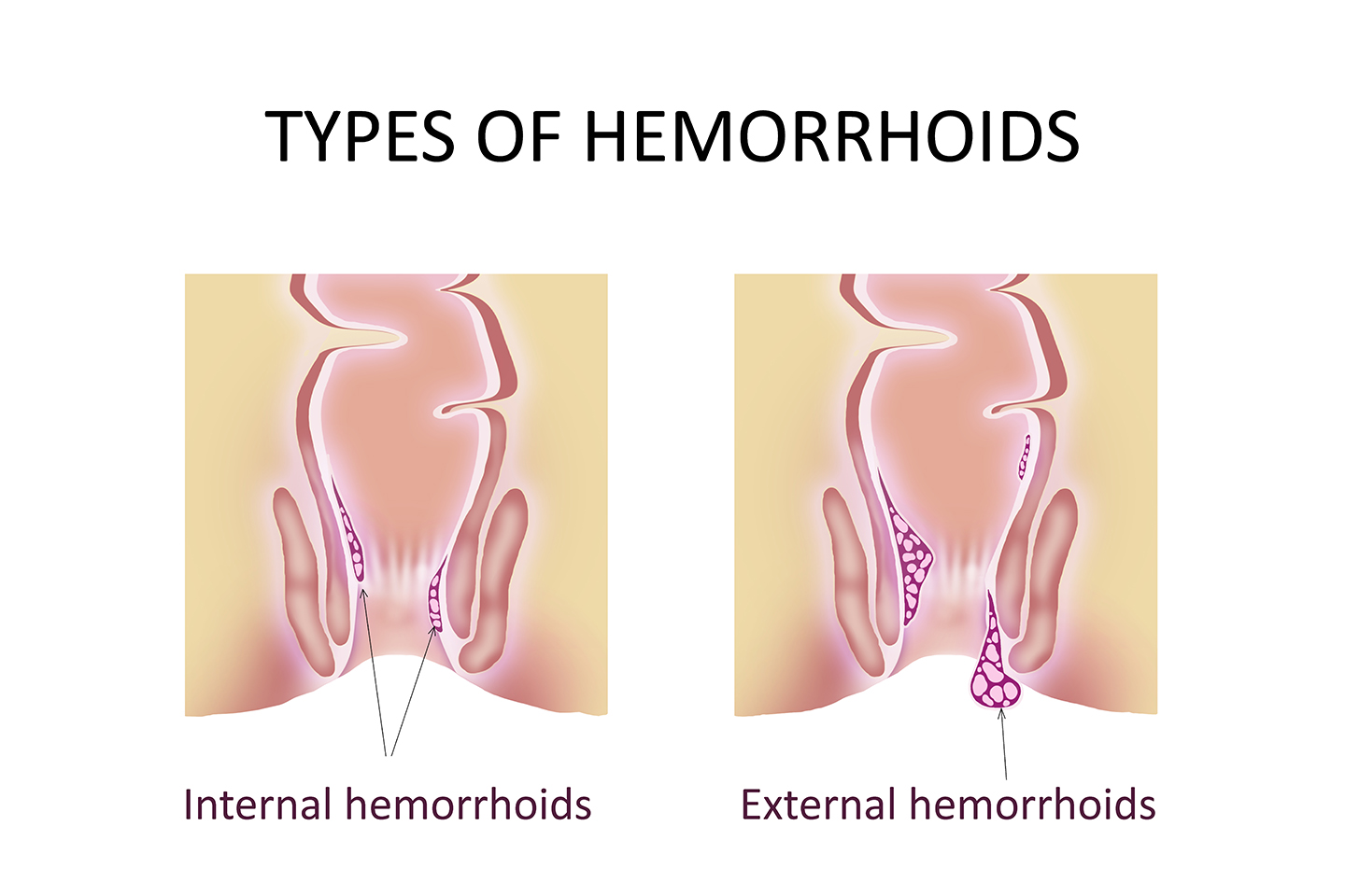internal hemorrhoid bleeding