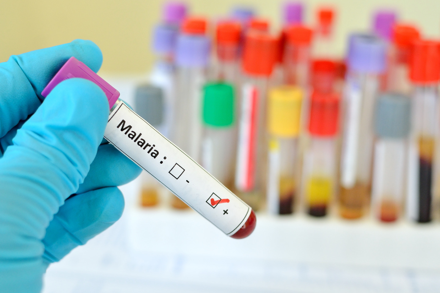 Simplifying Malaria Diagnosis for Healthcare Professionals