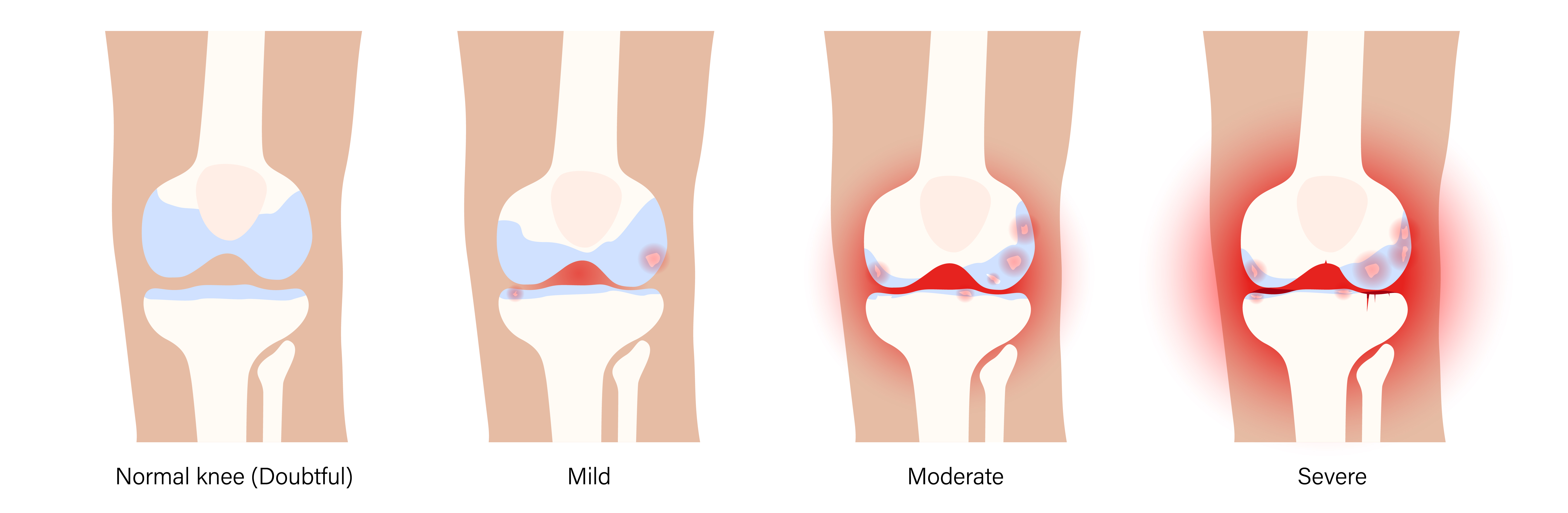 Osteoarthritis vs rheumatoid arthritis: how are they different?