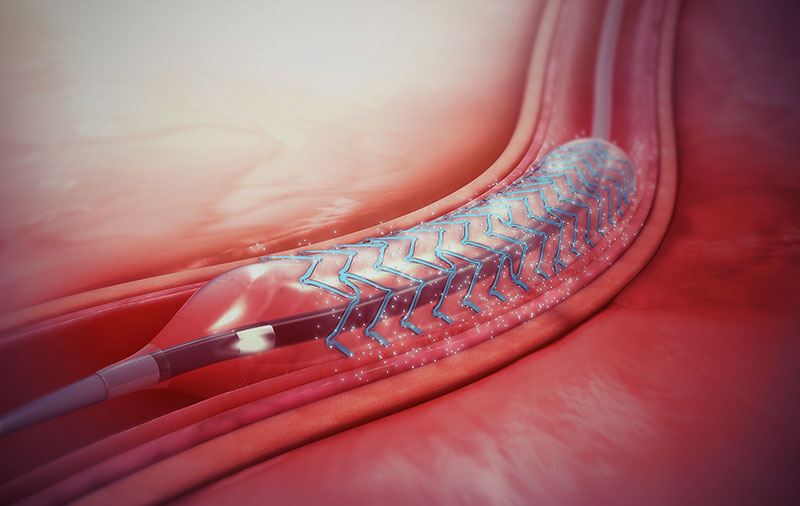 What Is A Better Option For Angioplasty? A Bare Metal Stent Or A Drug-eluting Stent?
