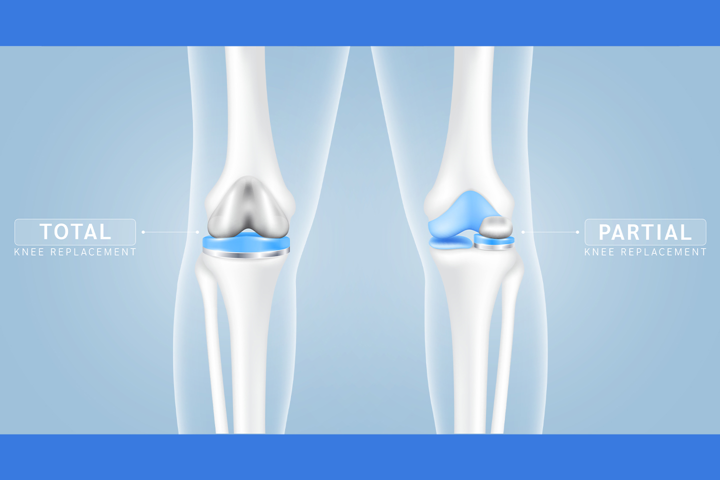 Total knee replacement and partial knee replacement - Meril Life