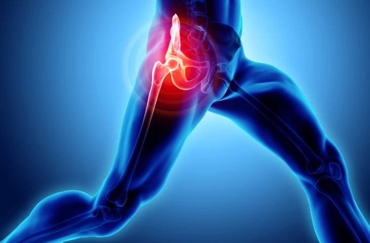 What Is Hip Osteoarthritis?