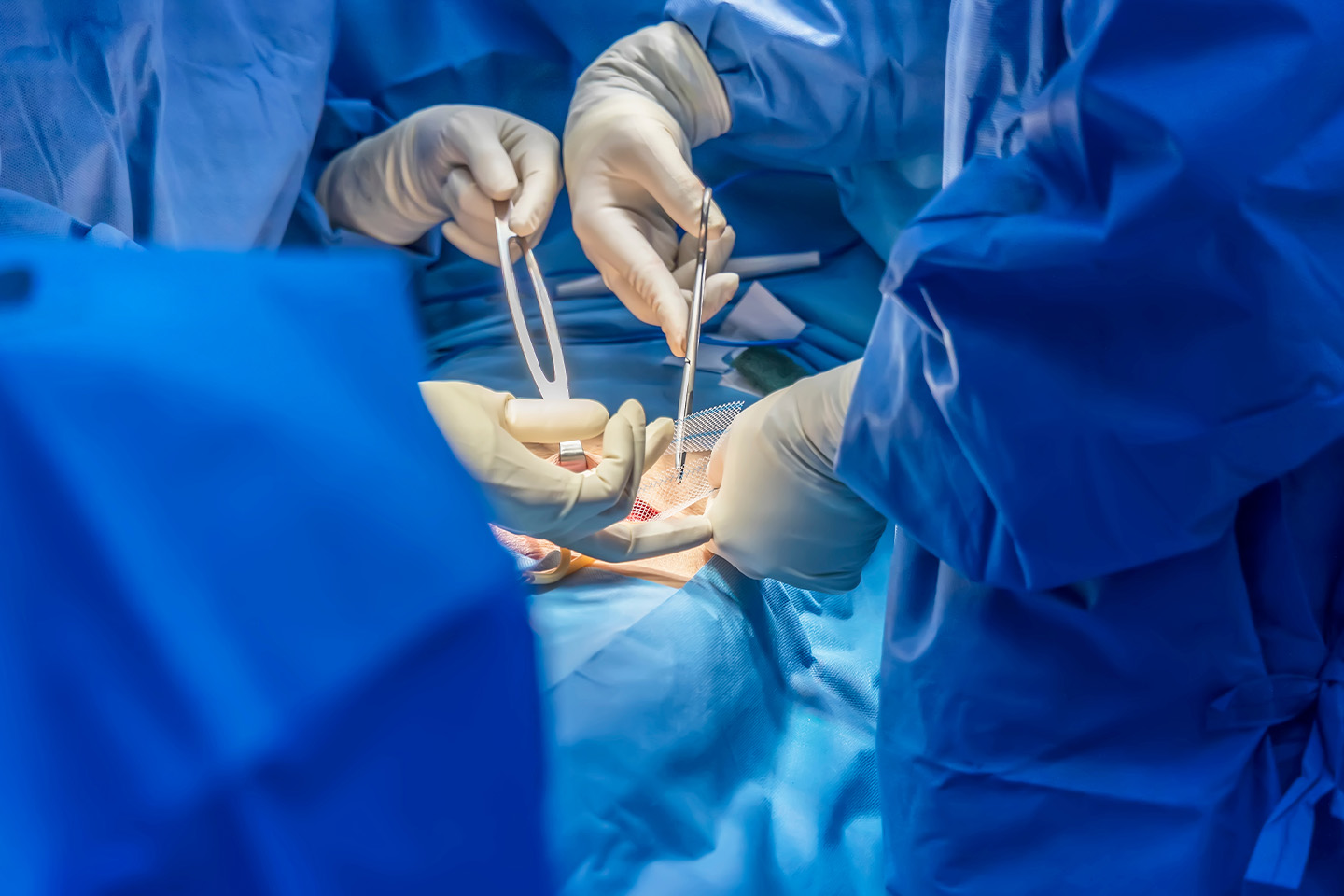 The Crucial Role of Mesh Selection in Hernia Surgery - Understanding the Impact