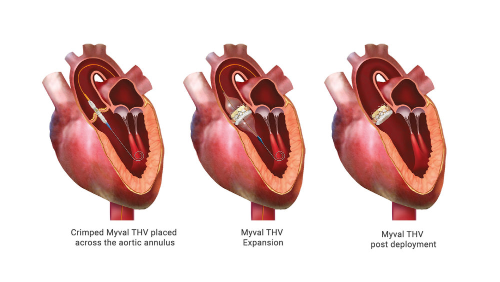 The First TAVI Surgery With Myval Valves At The Sant'Ambrogio Clinical