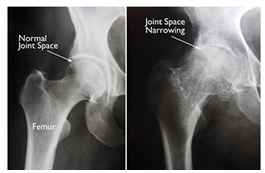 X-rays of normal hip & Joint Space Depletion in hips