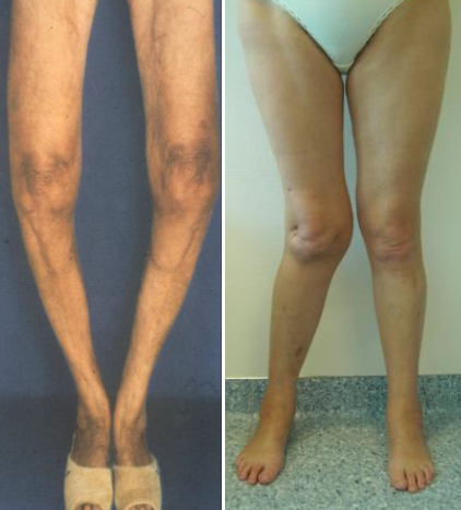 Knee Deformities