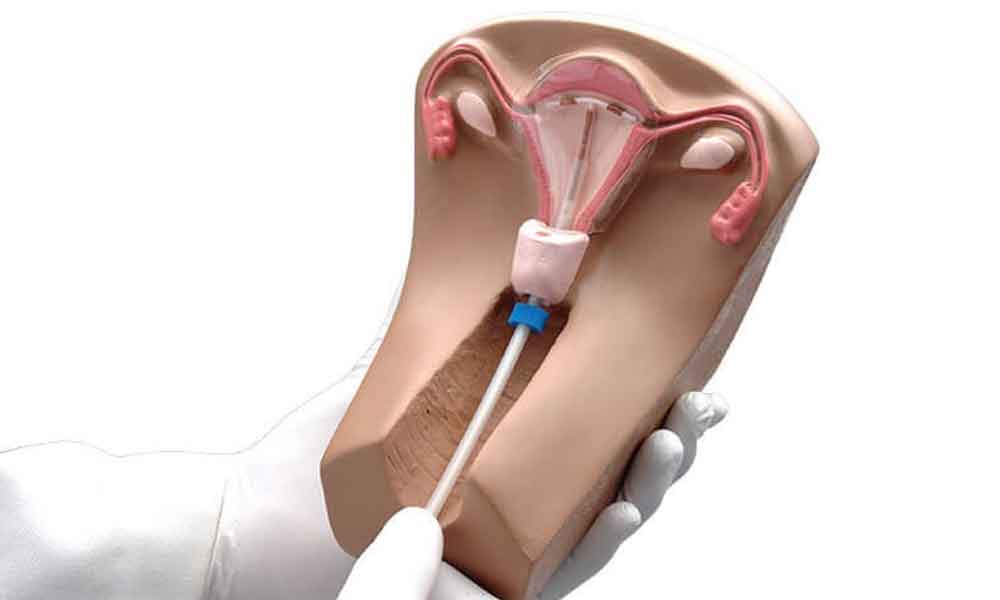 Global Intrauterine Contraceptive Devices Market 2020 Growth Analysis 