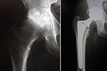 X-rays before and after total hip replacement