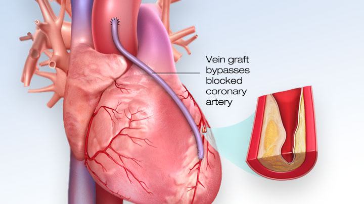 coronary-artery-bypass-grafting-in-nashik-dr-rahul-kaiche-bypass