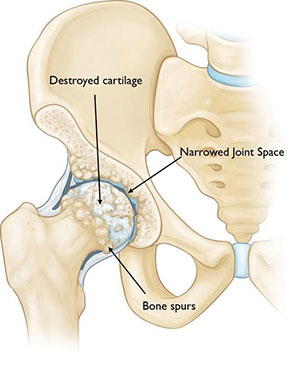 Hip osteoarthritis and components