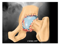 Hip Joint with arthritis - Hip Replacement Surgery