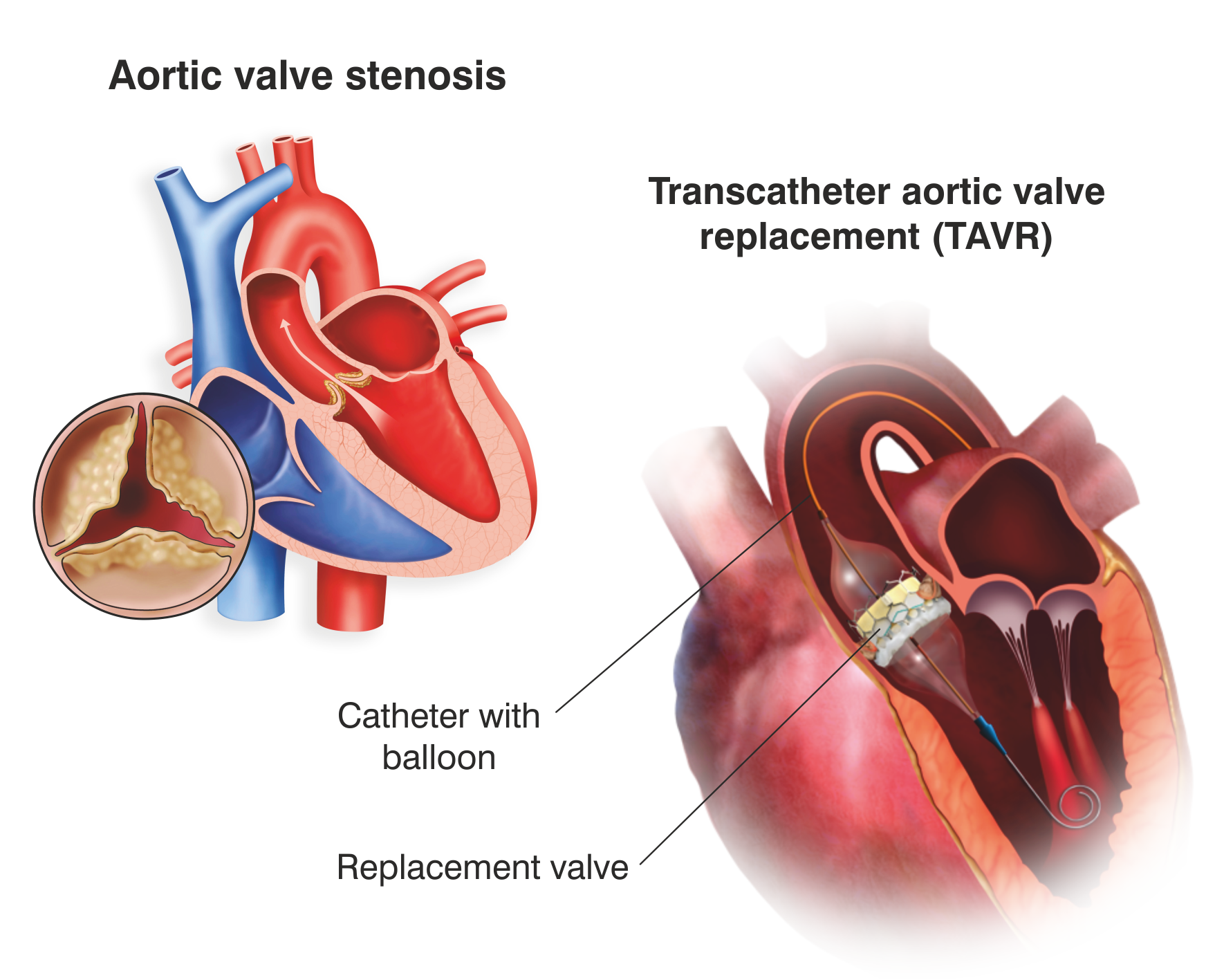 A visual representation of TAVR and aortic valve stenosis in the heart.