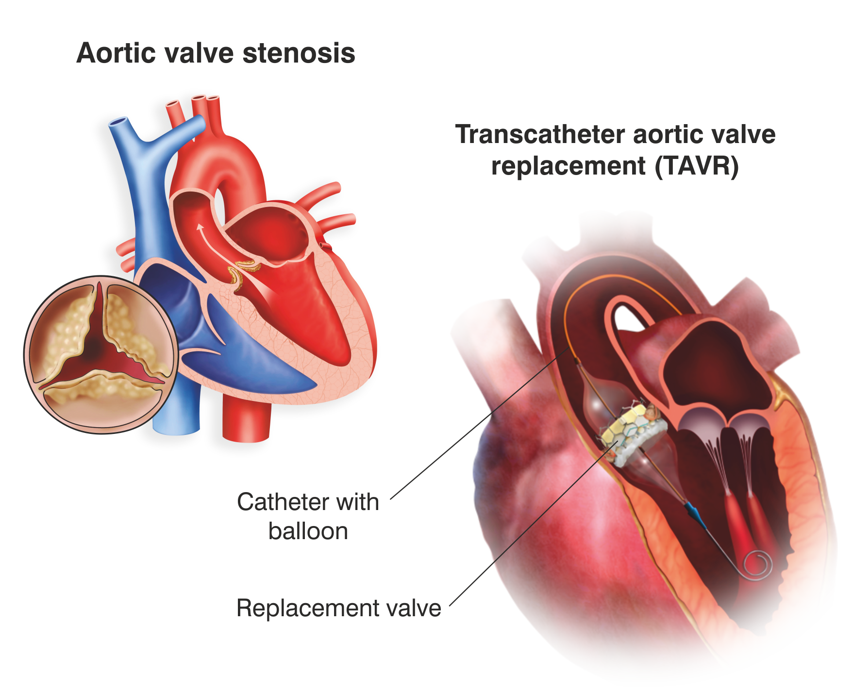 Myval For Aortic Stenosis Transcatheter Aortic Heart Valve 