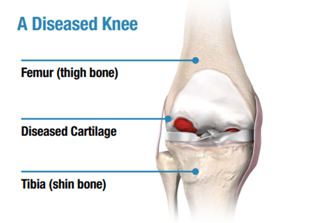 A guide to Diseased Knee - Total Knee Replacement Surgery