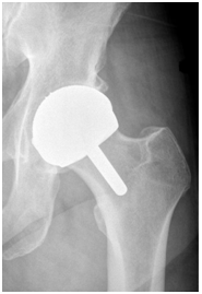 Total Hip Replacement Surgery - Orthopedics Implant