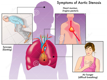 Symptoms of Aortic Stenosis