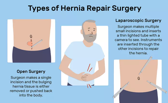 All About Hernia Surgery & Its Treatment